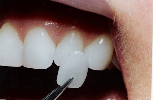Information in Dental Veneers